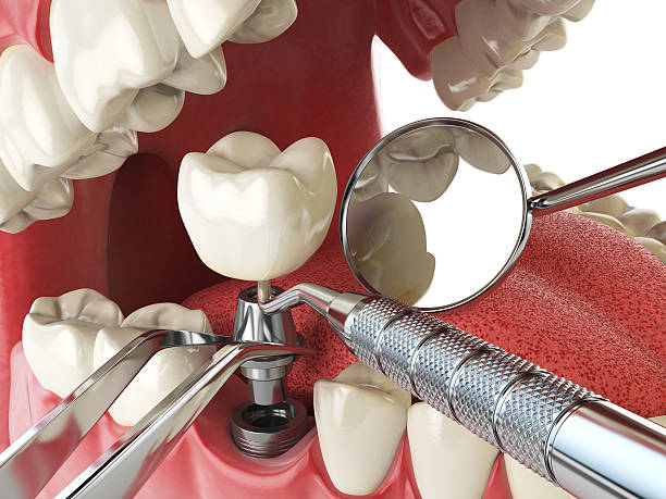 Best Emergency Root Canal Treatment in Anderson, CA